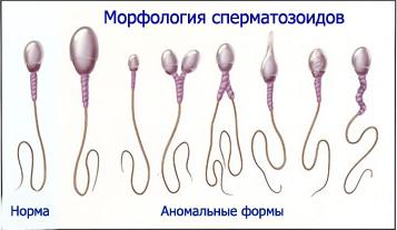 мужское бесплодие морфология сперматозоидов