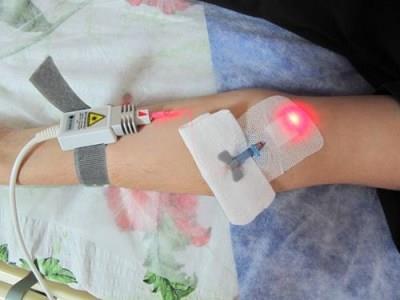 лазерное облучение крови при генитальном герпесе